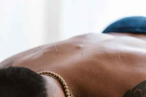 Acupunctuur